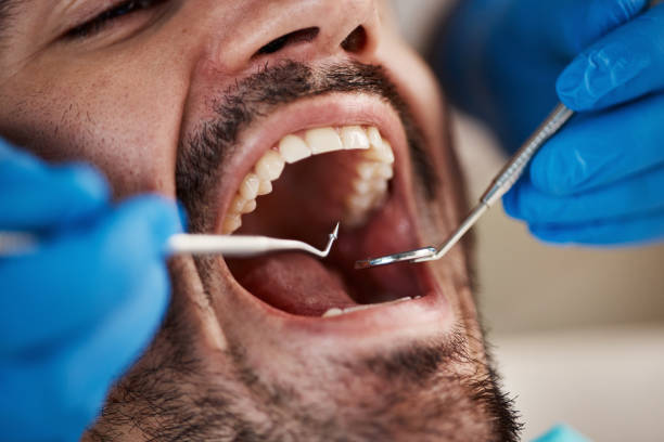 Best Emergency Dental Care for Broken or Chipped Teeth in Lexington, SC