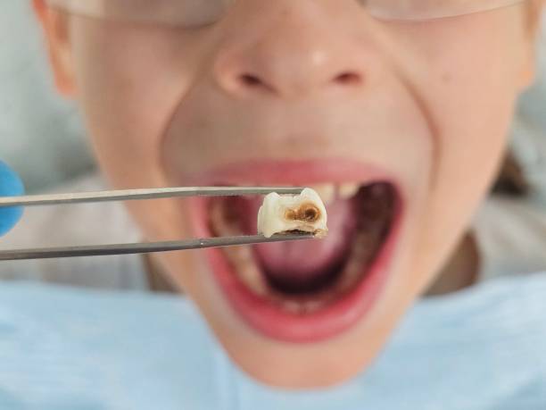 Best Emergency Tooth Extraction in Lexington, SC